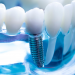 What to look for in a Dental Implant Surgery Center?