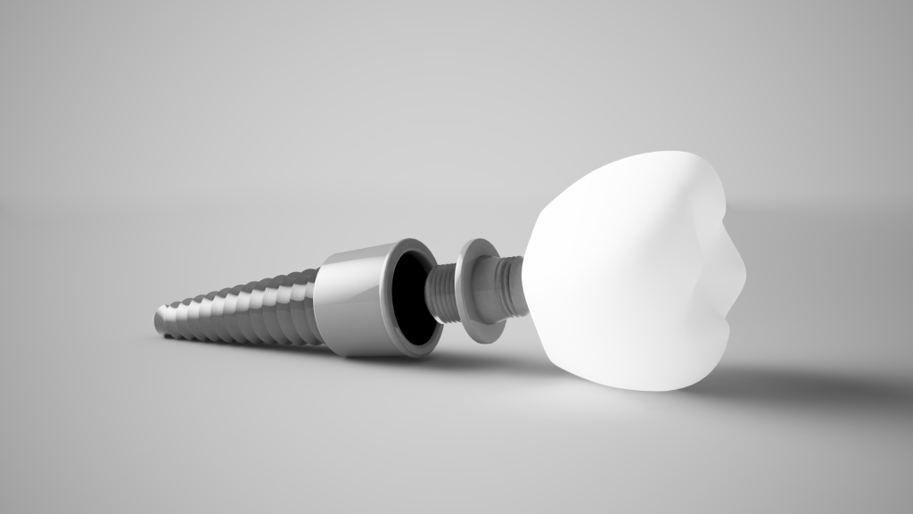 Dental implants in Norman, OK