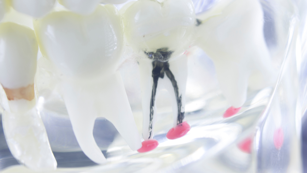 Why root canals are not scary