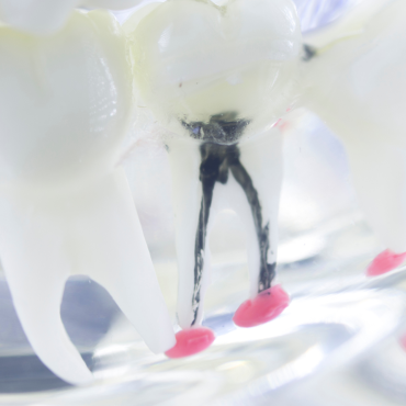 What you need to know about a root canal