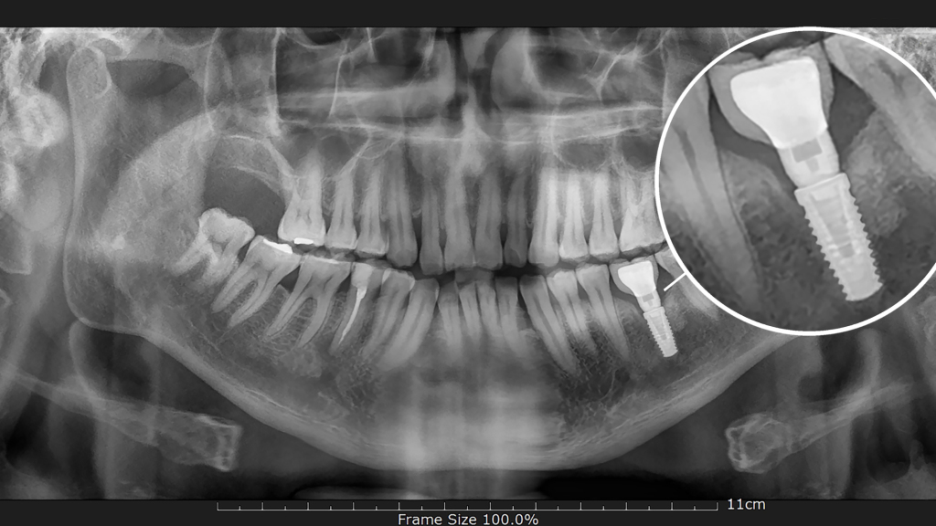Dental Implant Center in Norman, OK